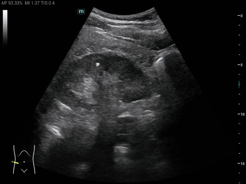 MX5 Compact Ultrasound System - Clinical Image - Kidney