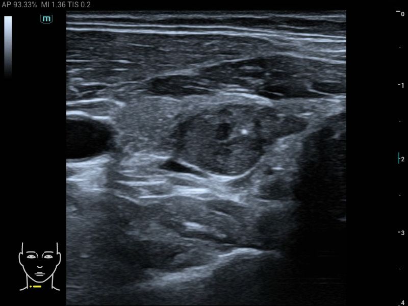 MX5 Compact Ultrasound System - Clinical Image - Thyroid