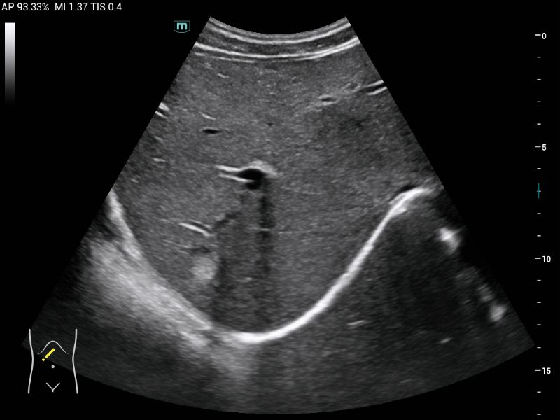 MX6 Compact Ultrasound System - Clinical Image - Abdomen