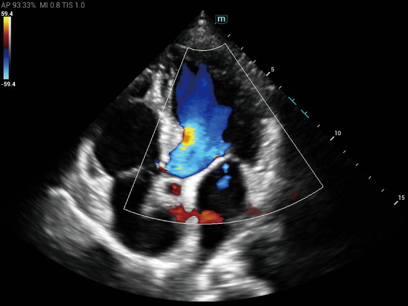 MX6 Compact Ultrasound System - Clinical Image - Cardiology