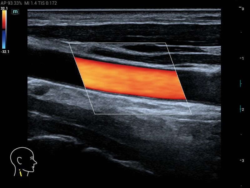 MX6 Compact Ultrasound System - Clinical Image - Carotid