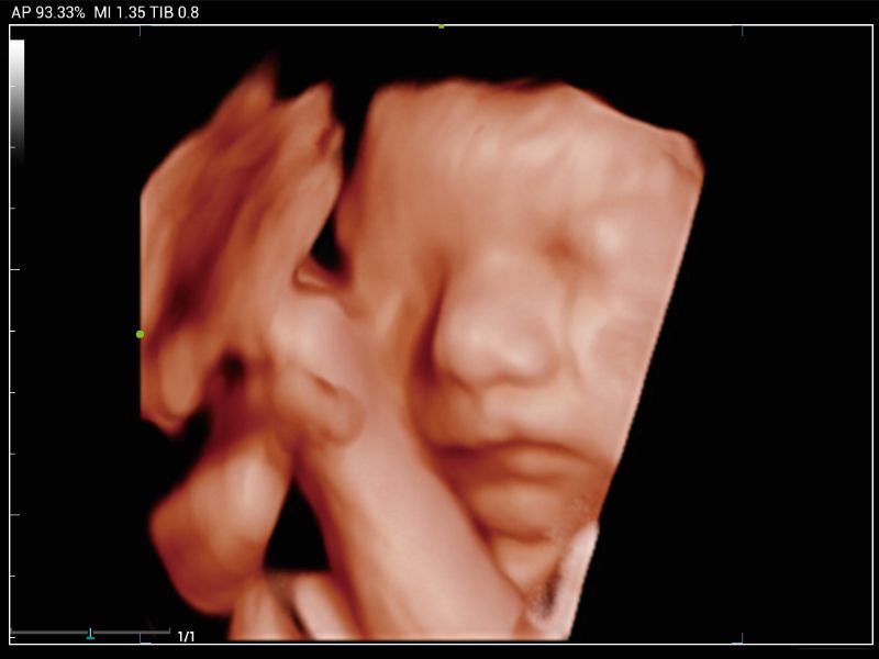 MX6 Compact Ultrasound System - Clinical Image - Fetus