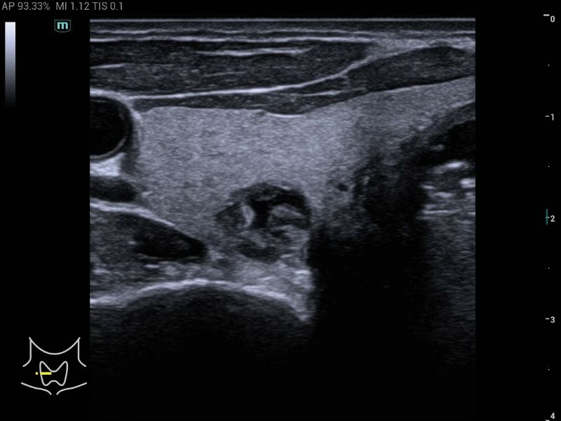 MX6 Compact Ultrasound System - Clinical Image - Thyroid