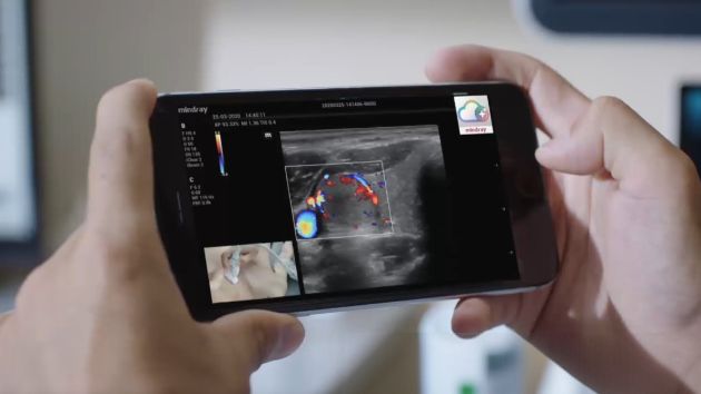 MX6 Compact Ultrasound System - connect with MiCo+ App