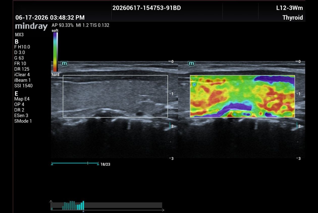 Natural touch elastography
