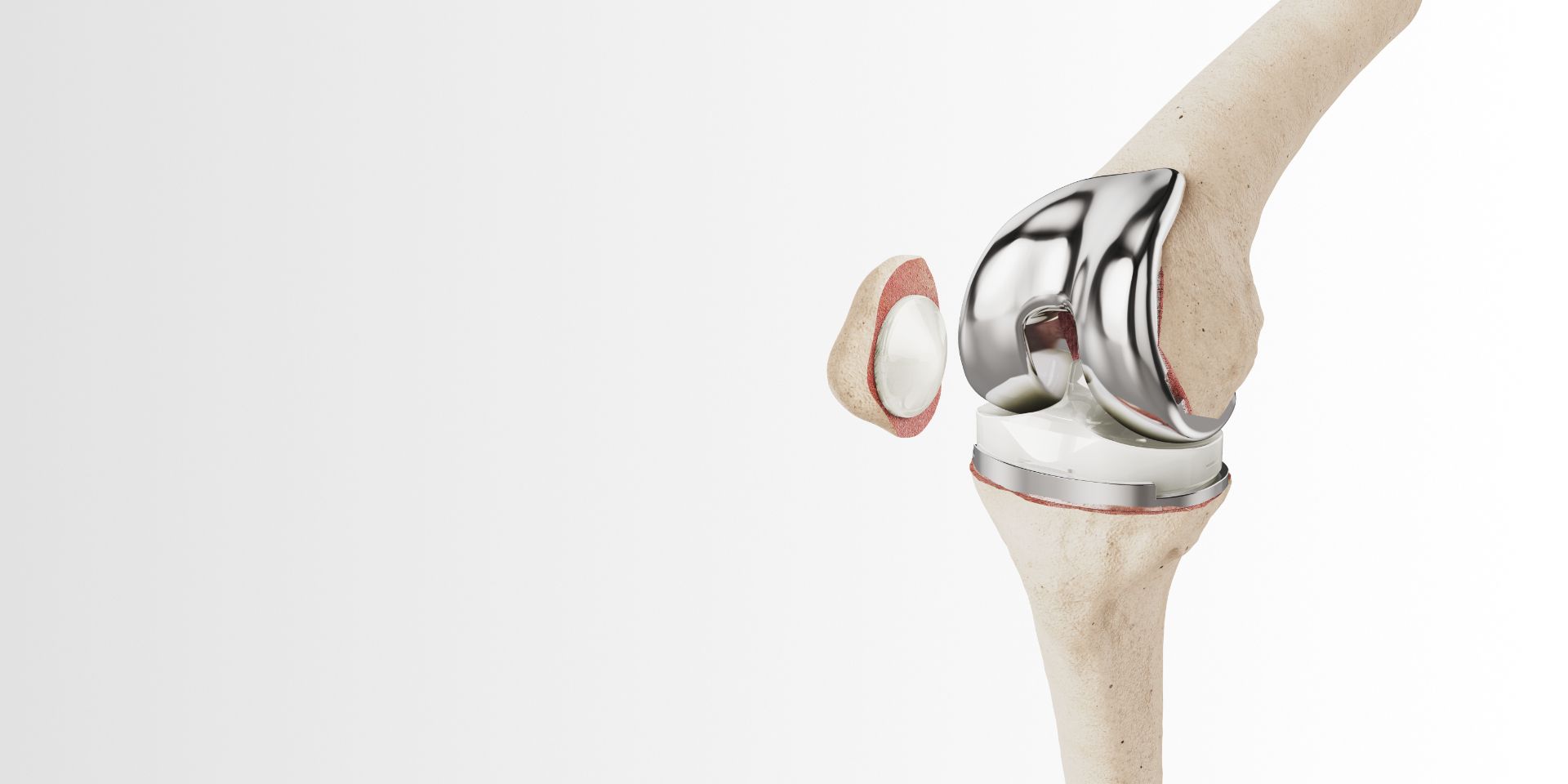 orthopaedics-mk-ps-fixed-bearing-knee-kv-pc-1.0-en