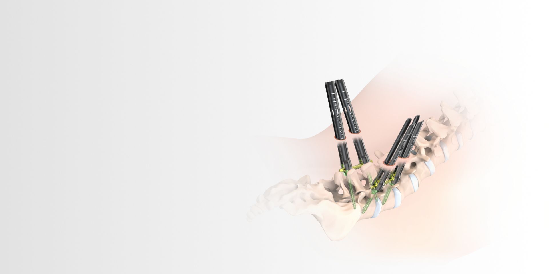 orthopaedics-ms-mis-posterior-pedicle-screw-systm-cemented-kv-pc-1.0-en