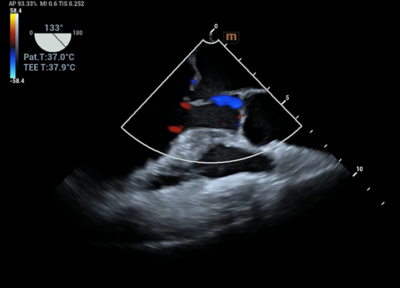 Recho R9 clinical image - Posterior mitral  valve prolapse