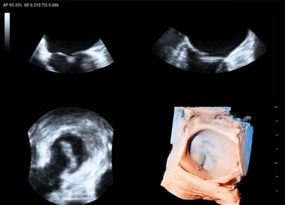 Recho R9 clinical image - D imaging of mitral valve (left atrial view)
