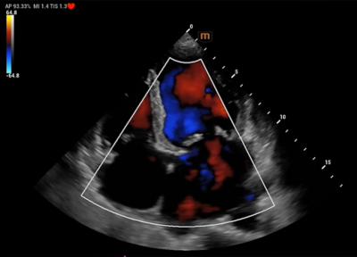 Recho R9 clinical image - Mitral and tricuspid valve regurgitation