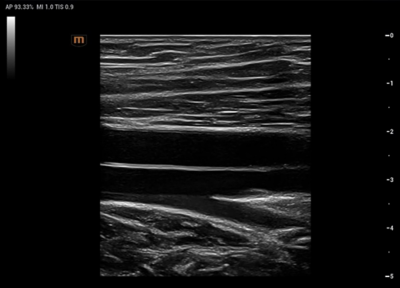 Recho R9 clinical image - Popliteal artery and vein