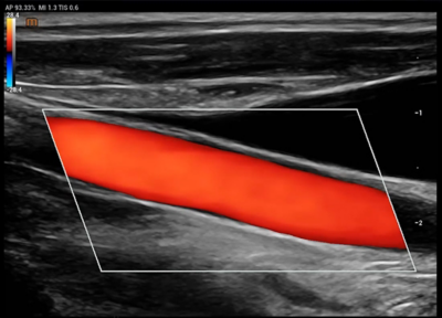 Recho R9 clinical image - Carotid blood flow