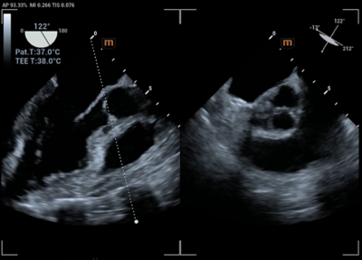 Recho R9 clinical image - Mid-esophageal X-Vue for long axis view