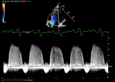 Recho R9 clinical image - Spectrum of aortic valve regurgitation