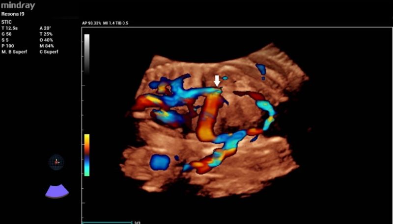 3D color reconstruction of the abnormal ductus venosus drainage into the inferior vena cava (white arrow)