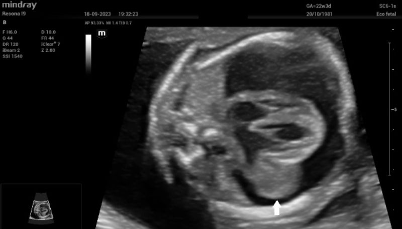 eptal four-chamber view of the fetal heart. The teratoma (white arrow) is clearly seen at the level of the mitral valve