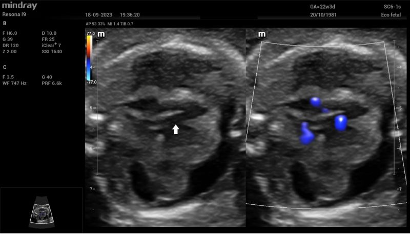 Septal four-chamber view of the fetal heart on dual 2D and Color Doppler imaging. A wide ventricular septal defect (white arrow) is clearly seen