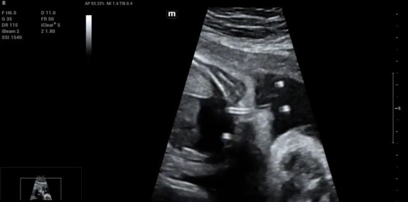 Harrison catheter (double pig tail) can be seen inside the pericardial cavity (short hyperechogenic parallel lines on the left), through the fetal thoracic wall (long hyperechogenic parallel lines in the middle of the picture) and in the amniotic cavity (short hyperechogenic parallel lines on the right)