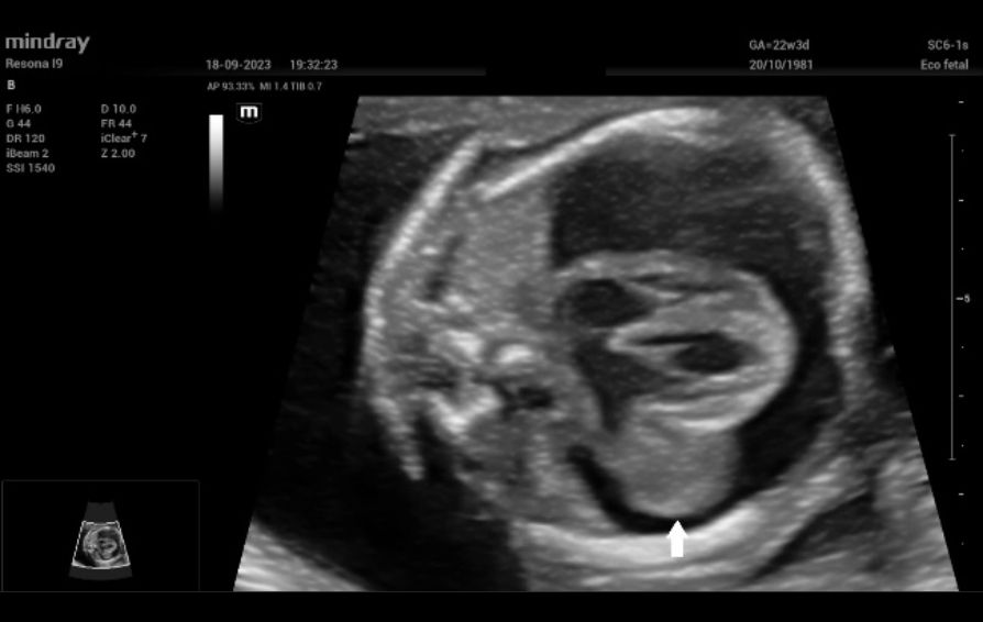 eptal four-chamber view of the fetal heart. The teratoma (white arrow) is clearly seen at the level of the mitral valve
