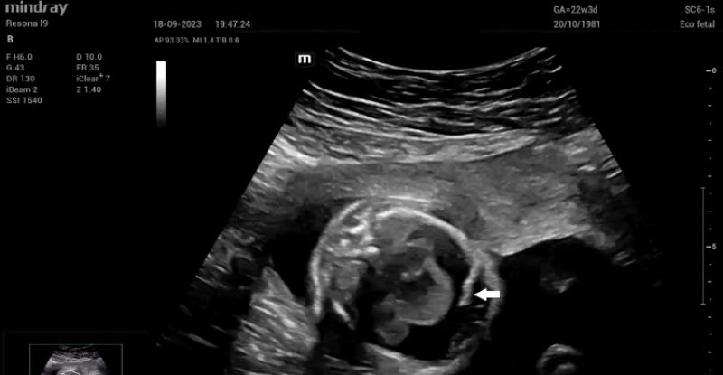 Ultrasound guided pericardiocentesis with an 18 Gauge needle (white arrox)