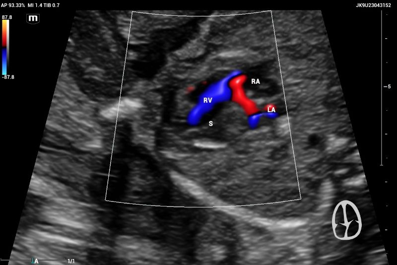 .  CASE Axial image of thorax.  The ultrasound, performed on the Mindray Resona I9 system, showed an asymmetric four-chamber view, a single right ventricle (RV) was noted and appeared significantly larger than the left ventricle (LV)