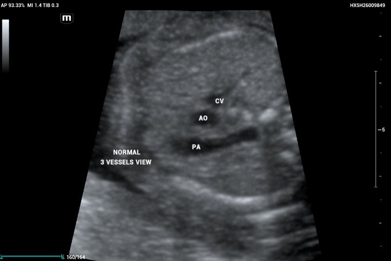 An example of an axial thorax image showing a normal 3-vessel view demonstrates the presence of the cava vein (CV), aorta (AO), and pulmonary artery (PA) with similar size (relation 1:1)