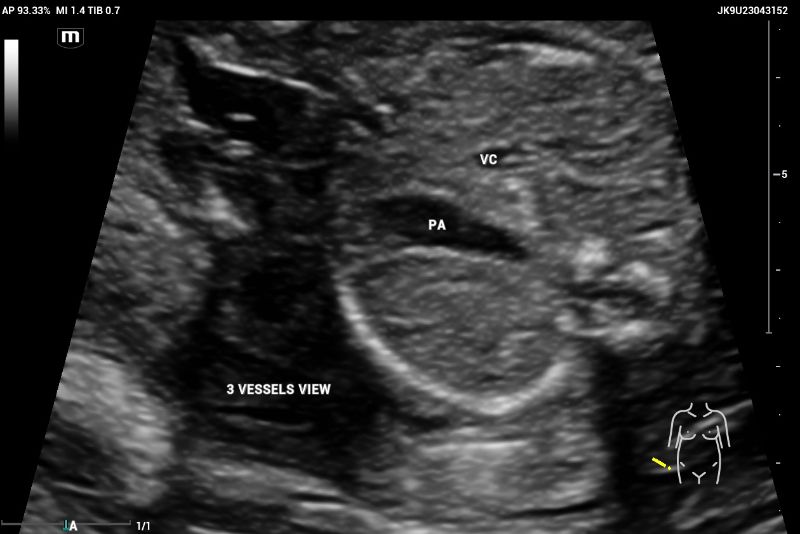 Axial image of thorax showing CASE with abnormal 3-vessel view demonstrates the absence of aorta between two vessels, the cava vein (CV) and pulmonary artery (PA), suggesting aortic atresia