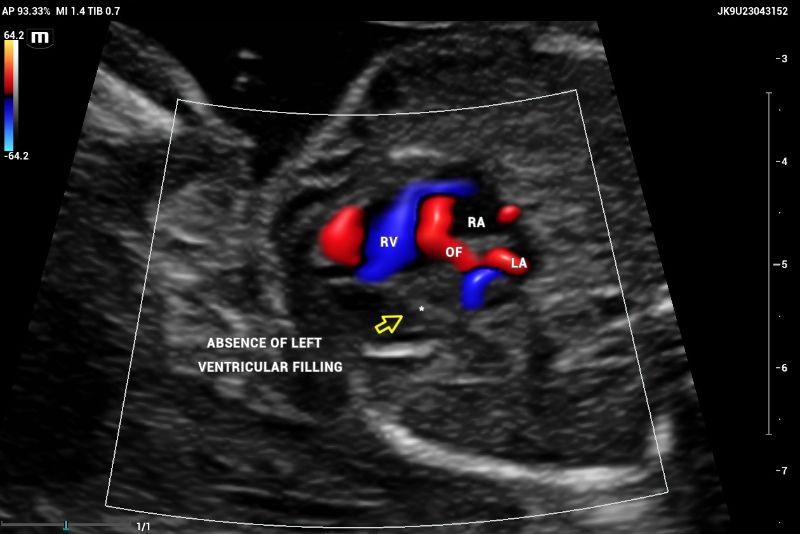CASE Fetal echocardiography. Absent color Doppler could be visualized by entering the left ventricle (arrow) through the mitral valve. Right ventricle (RV) with normal filling. Oval foramen with left-right shunt. Ultrasound compatible findings with Hypoplastic left heart syndrome (HLHS)