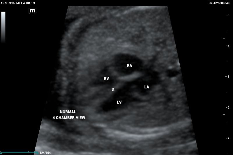 Example of Axial or transverse thorax image in fetal echocardiography showing a normal heart with symmetric 4-chamber view
