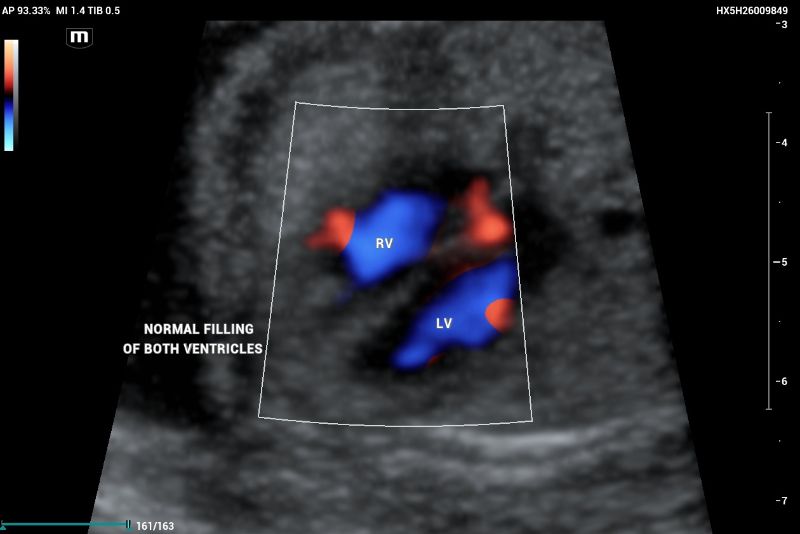 An example of normal echocardiography ultrasound screening showing Right ventricle (RV) and Left ventricle with normal filling