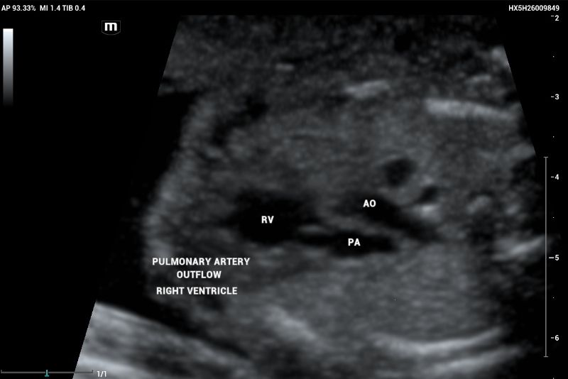 Example of normal echocardiography performed on Mindray Resona I9 system. Artery – ventricle concordance outflow tract showing pulmonary artery (PA) emerging of the right ventricle (RV)