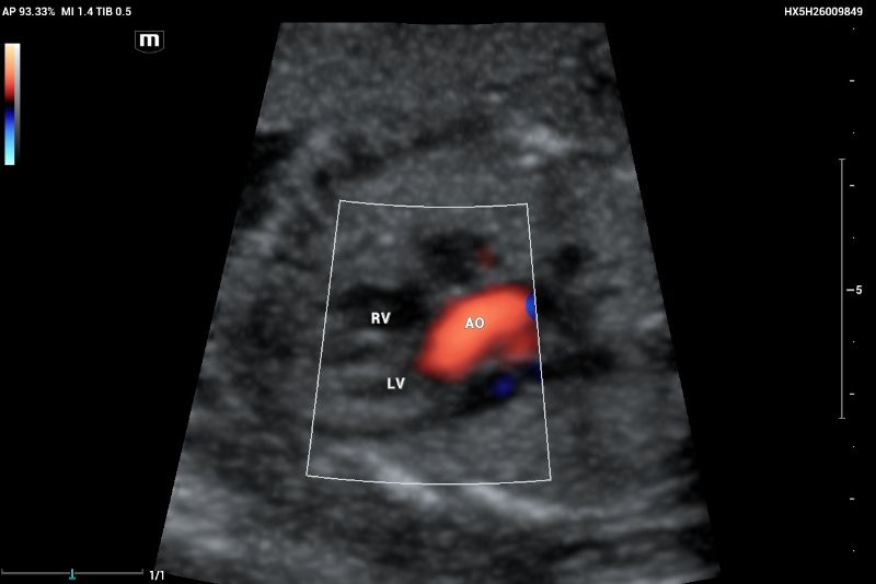 An example of normal echocardiography performed on Mindray Resona I9 system.  Artery–ventricle concordance showing the aortic outflow tract (AO) emerging of the left ventricle (LV)