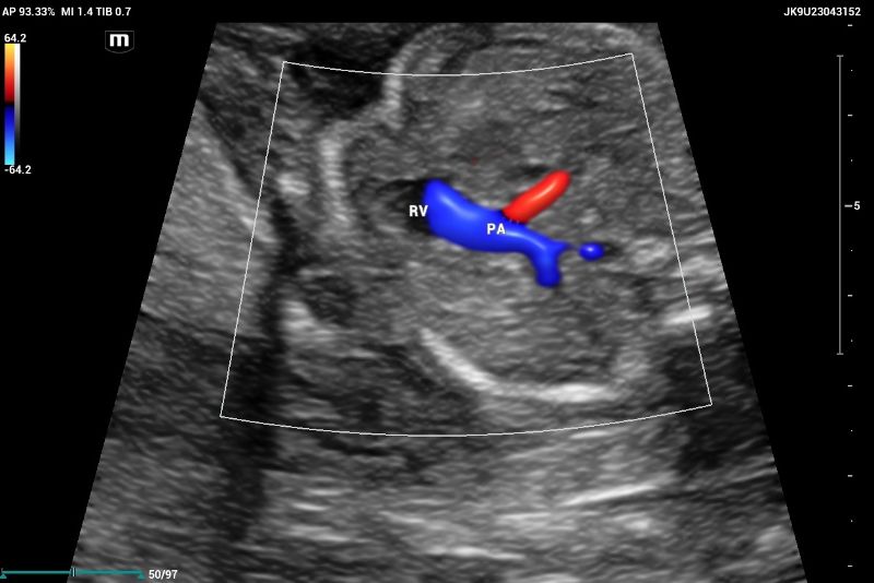 CASE Ultrasound performed on Mindray Resona I9 system. Color doppler showed outflow tract of pulmonary artery (PA) emerging of the right ventricle (RV)