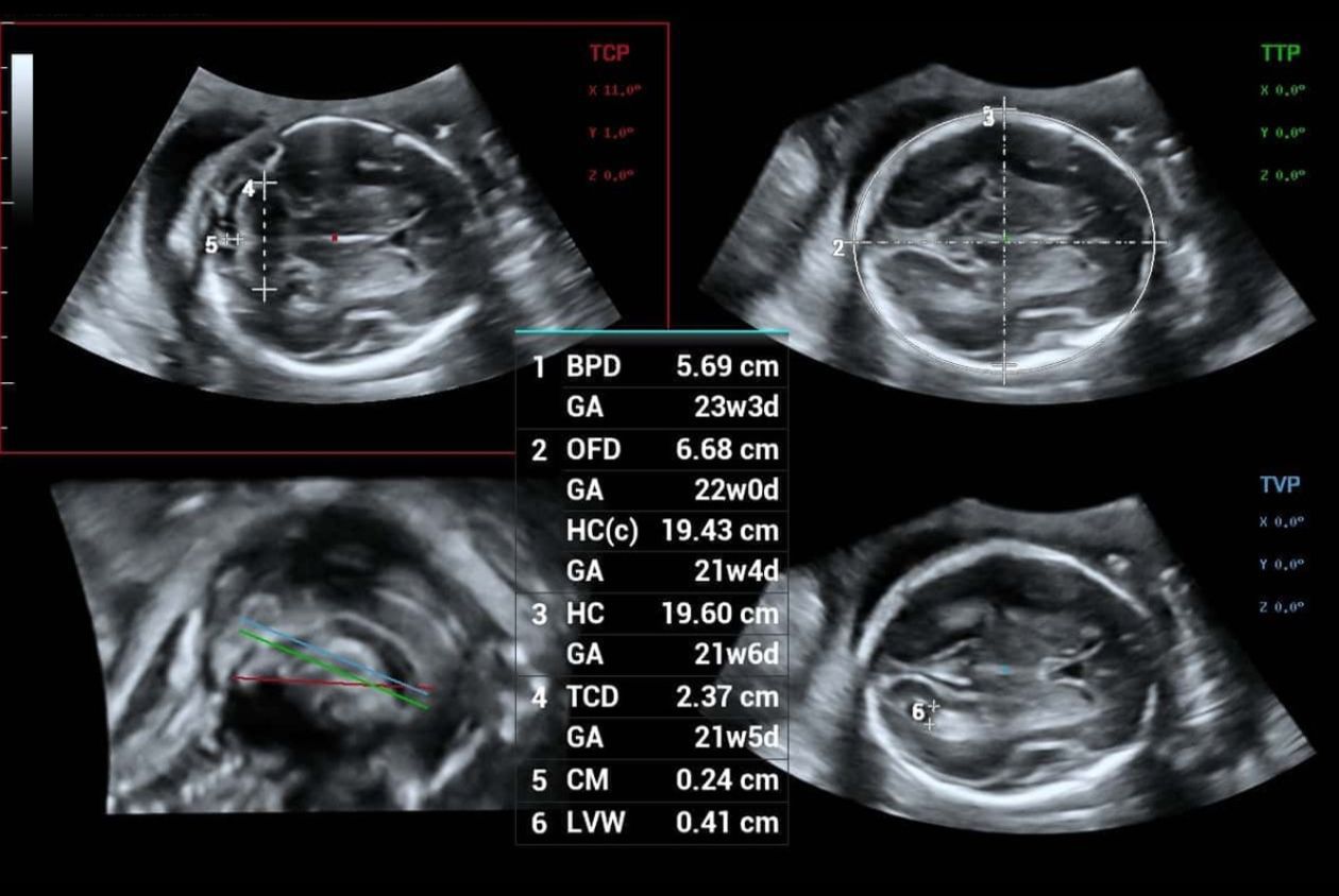 Smart OB auto measurements