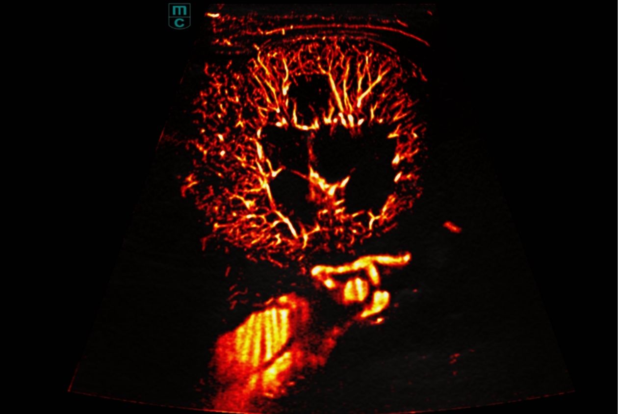 Product Image List Swiper Component 1260x844 - super-resolution-ceus-of-renal-perfusion-1260x844