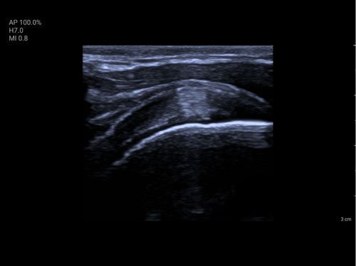 Product Teaser List 3 Cols PC - supraspinatus-500x374