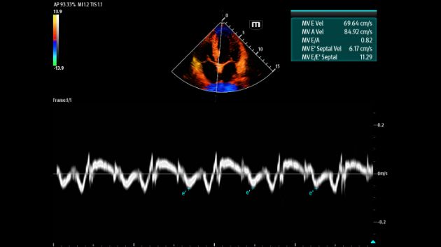 TEX20 Elite Edition Advanced Tools Clinical Image - Auto DFR (Auto Diastolic Function Ratio)