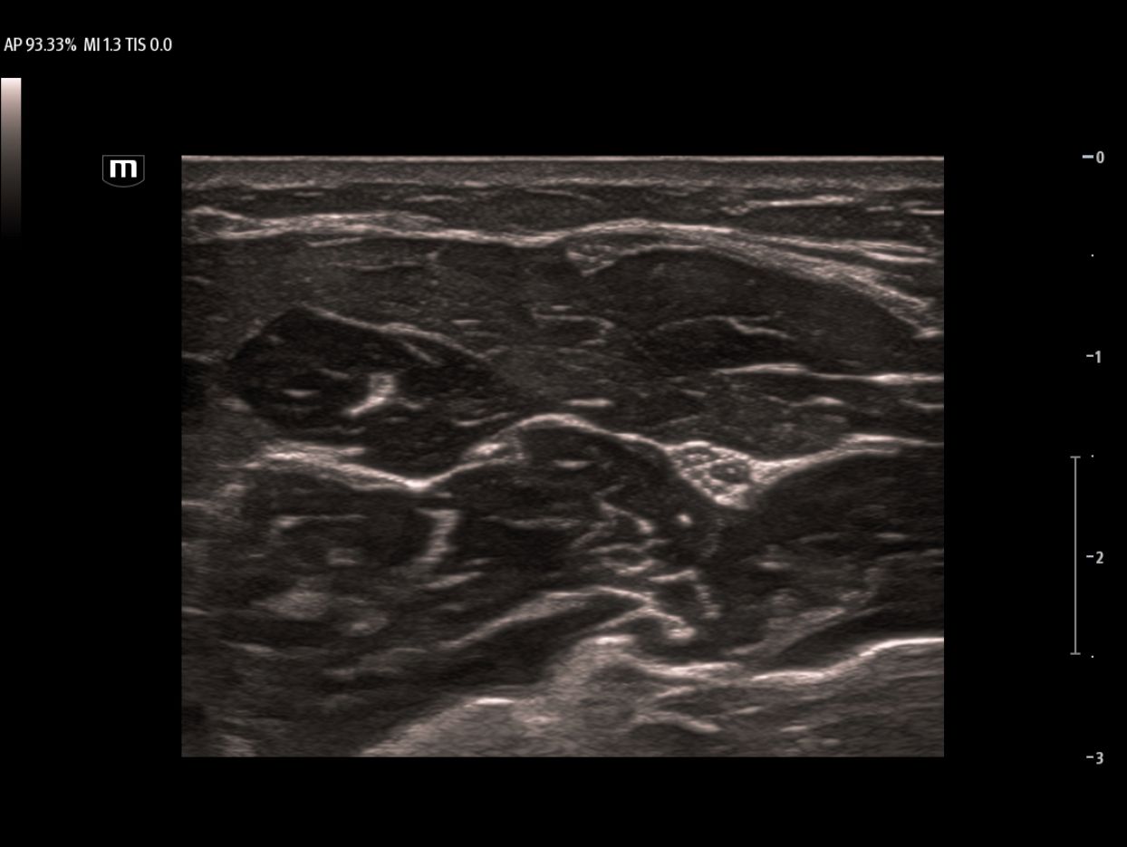 TEX20 Elite Edition Clinical Image - Median Nerve