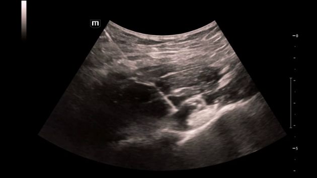 TEX20 Elite Edition - NET (Needle Enhancement Technology)