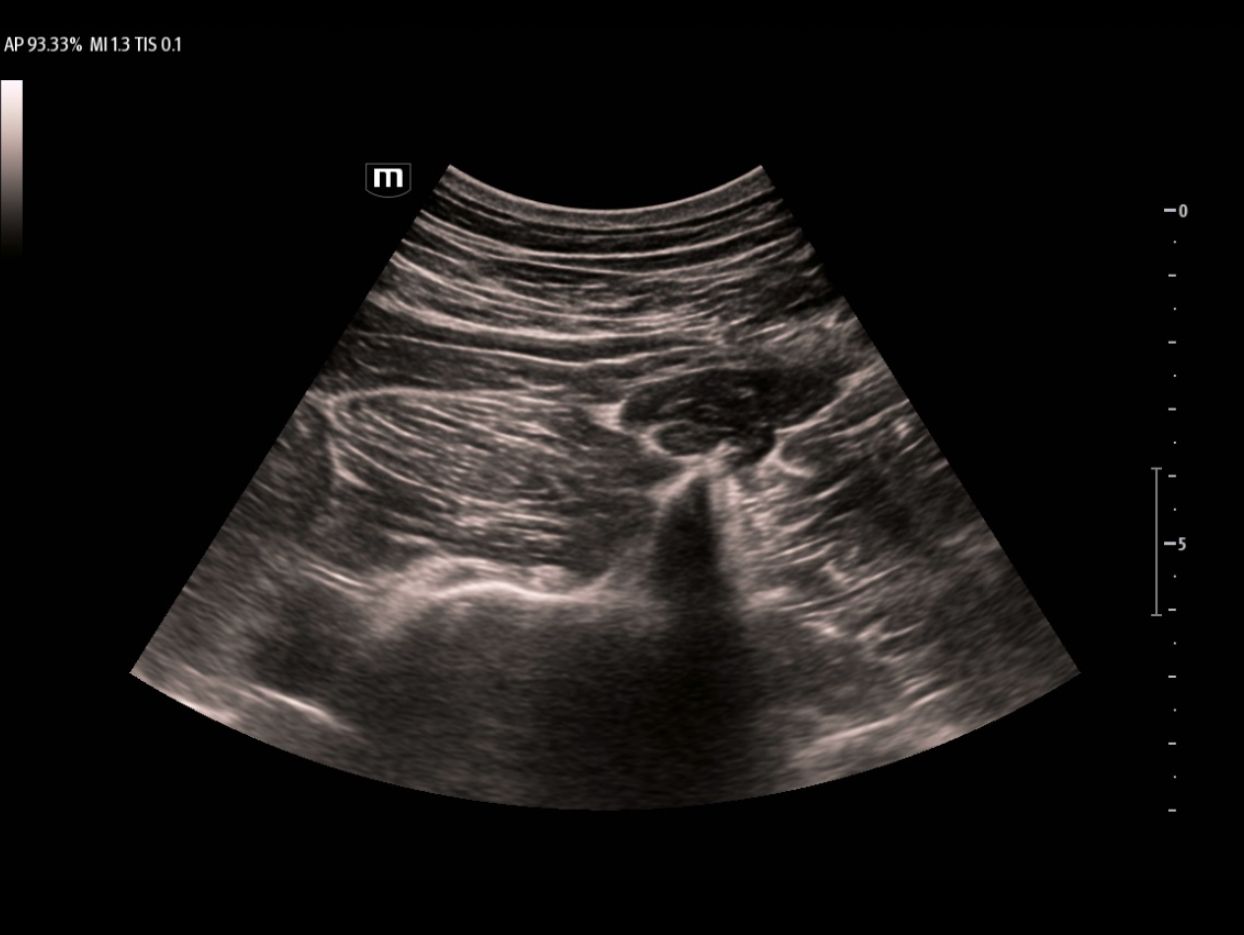 TEX20 Elite Edition Clinical Image - Quadratus Lumborum