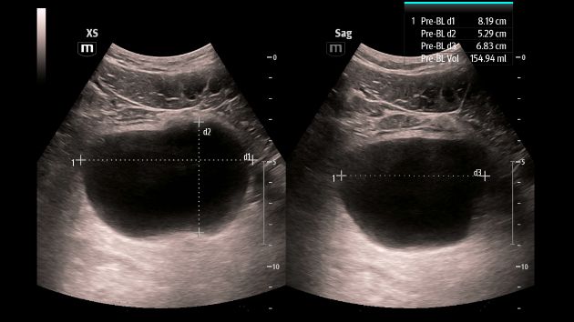 TEX20 Elite Edition Advanced Tools Clinical Image - Smart Bladder
