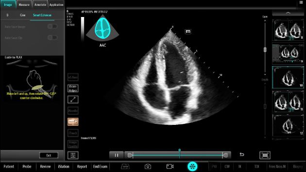 TEX20 Elite Edition Advanced Tools Clinical Image - Smart Echovue