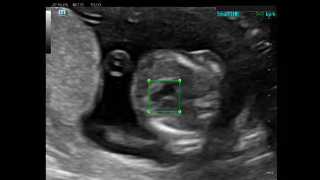 TEX20 Elite Edition Advanced Tools Clinical Image - Smart FHR OB1