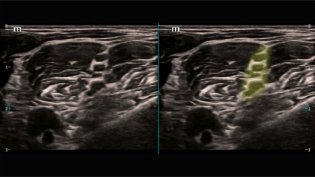 TEX20 Elite Edition Advanced Tools Clinical Image - Smart Nerve
