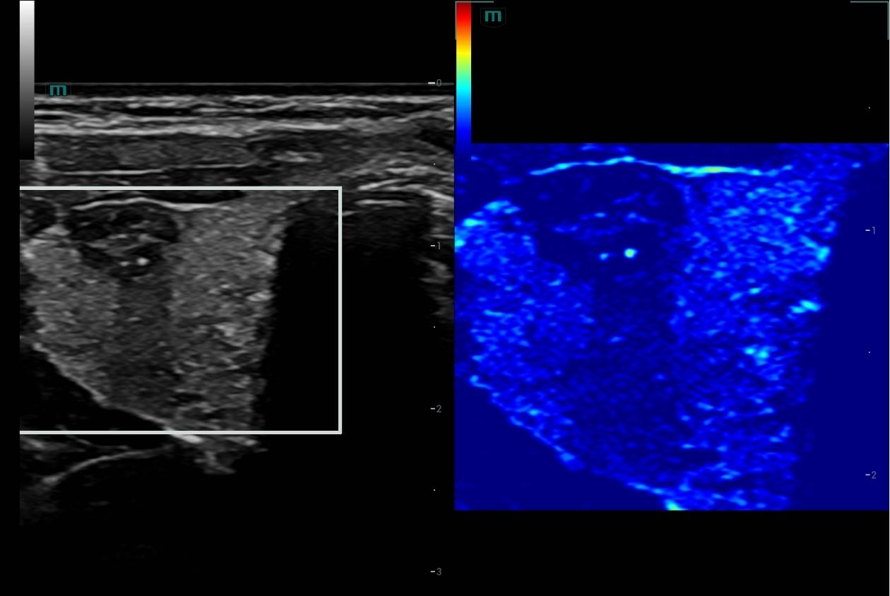Product Image List Swiper Component 1260x844 - thyroid-lesion-with-hd-scope-1260x844
