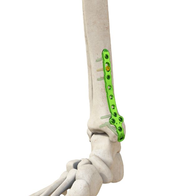 胫骨内踝锁定板T